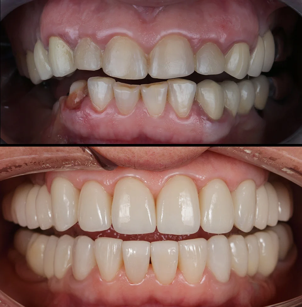 Crowns, bridges, and dentures treatment result
