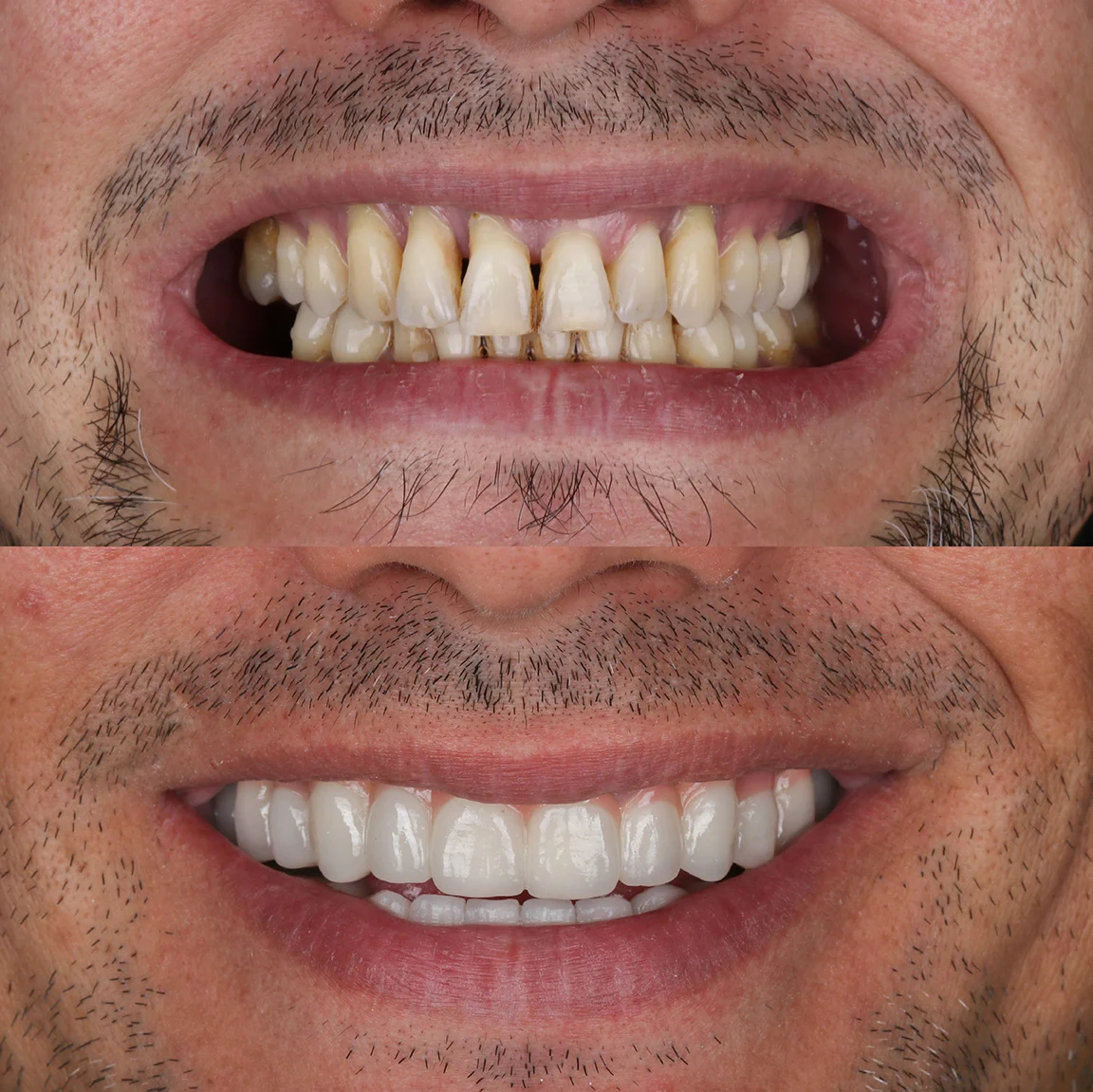 Dental implant treatment result