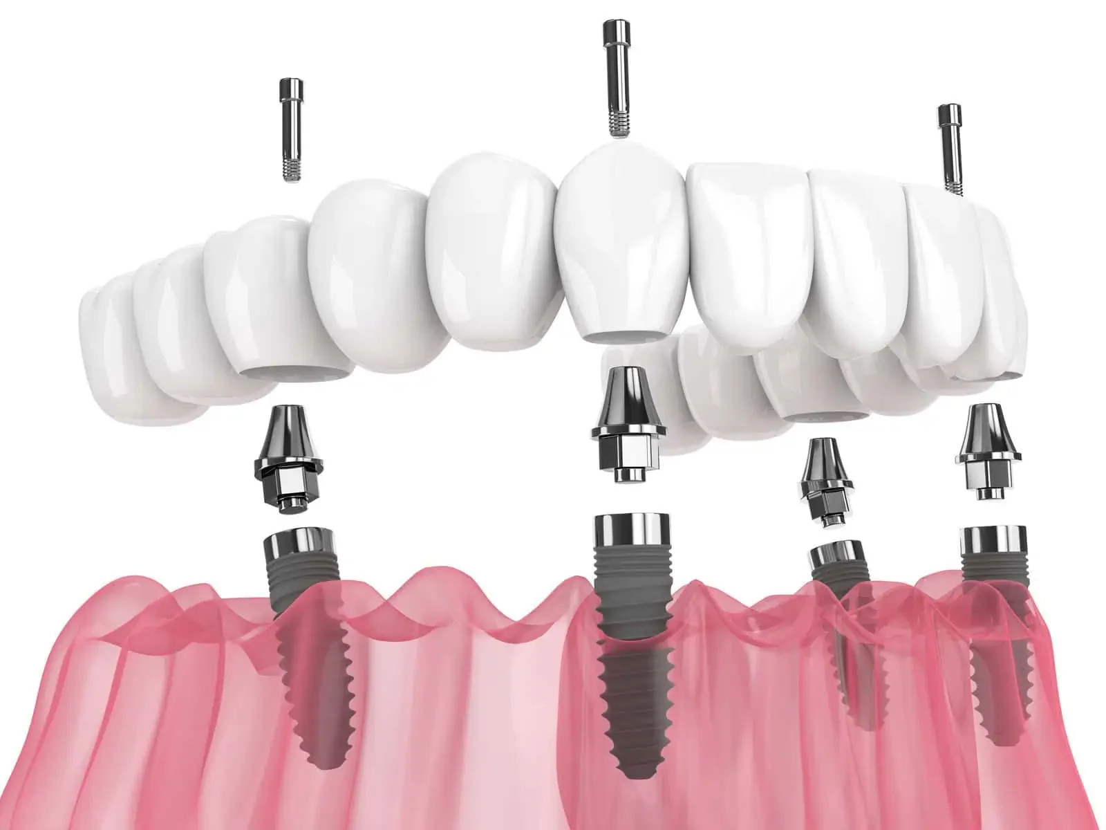 All-on-4 dental implant treatment at MM Dentistry