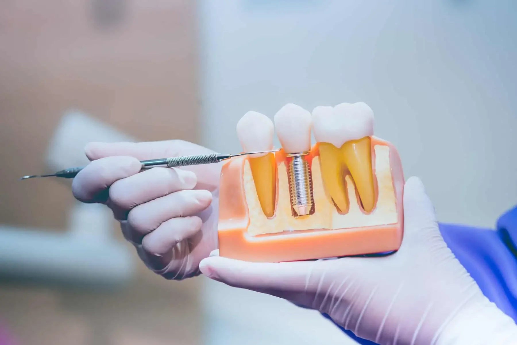 Dental implant care at MM Dentistry