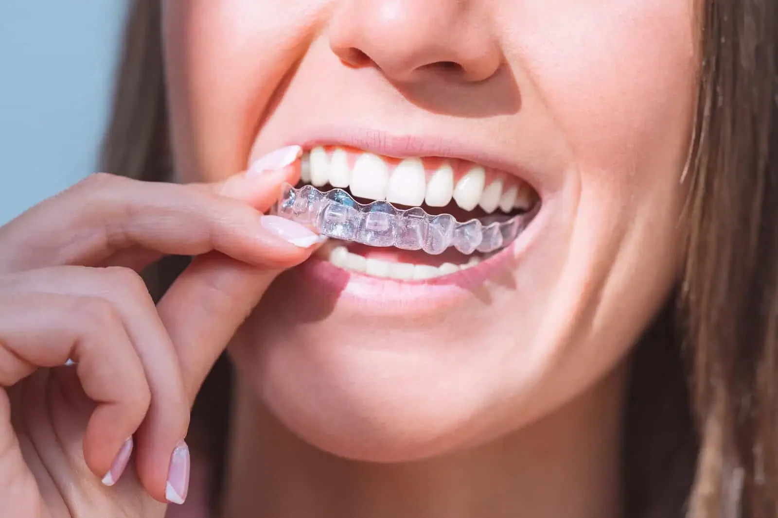 Invisalign Clear Aligners for Adults in Burke, VA