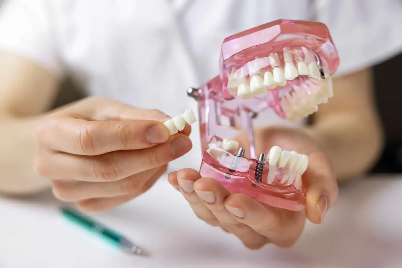 Fixed Dental Bridge in Burke, VA to Replace Your Missing Tooth