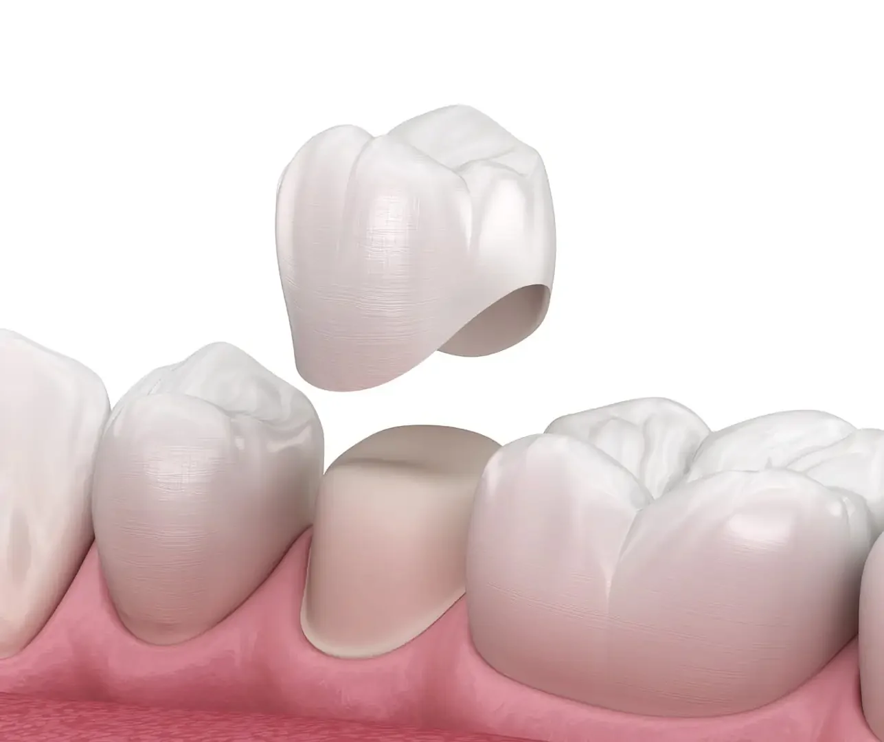 Dental crown treatment at MM Dentistry
