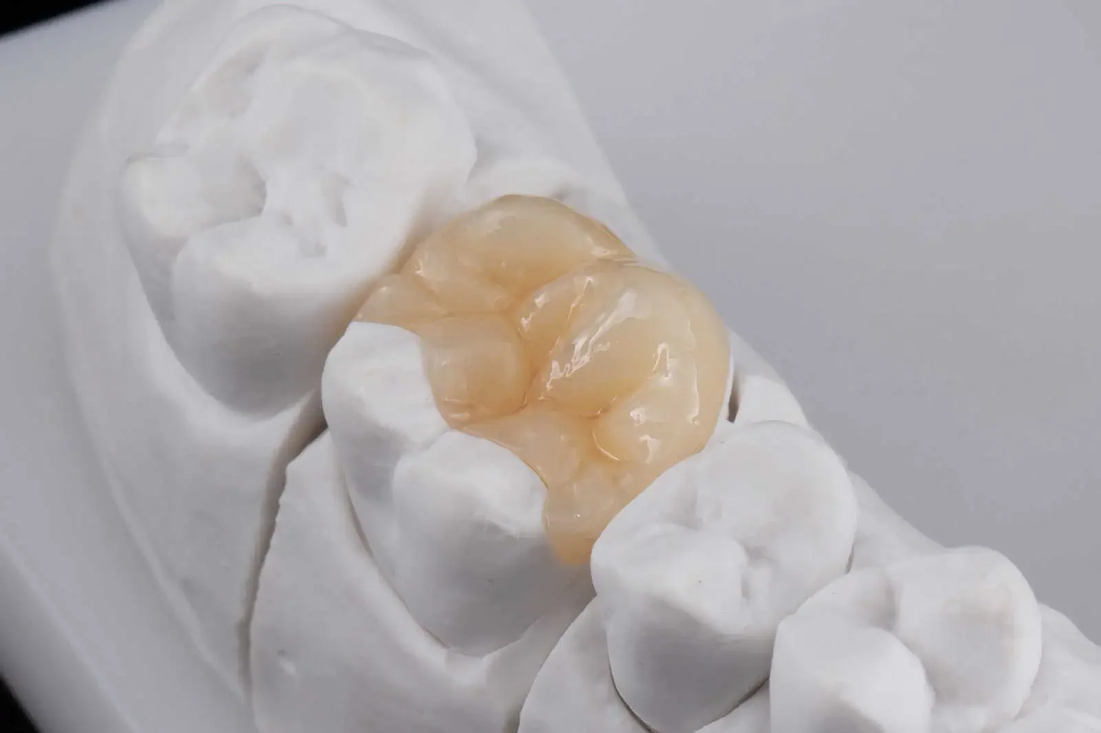 Inlays and Onlays in Burke, VA: Conservative Tooth Restoration