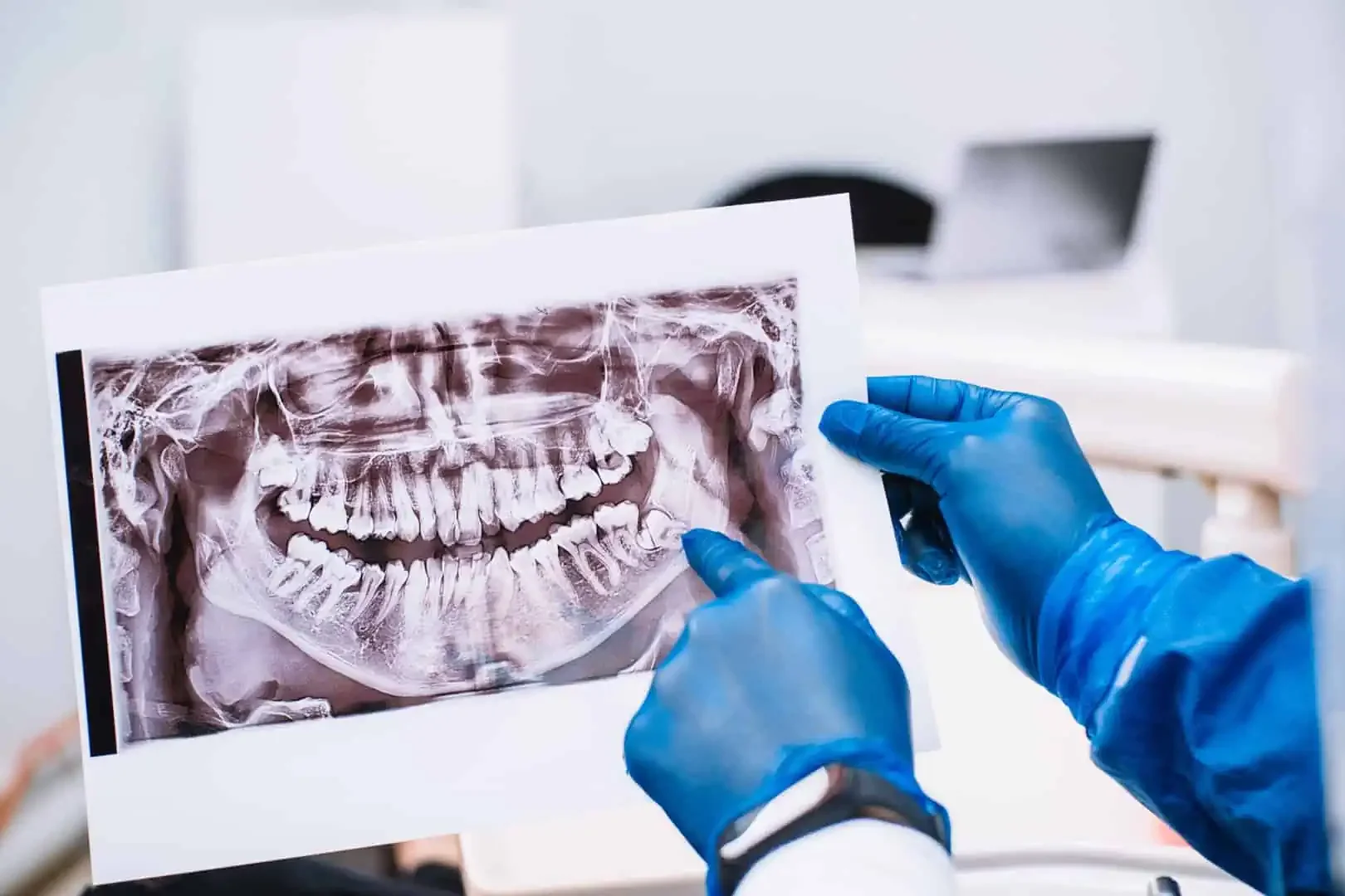 Wisdom Teeth Removal in Burke, VA: Gentle, Comprehensive Care